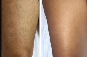 BA legs