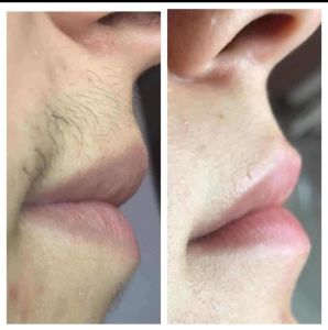 BA lip